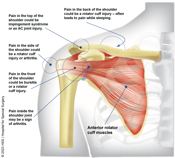 Causes of Shoulder Pain Without Injury