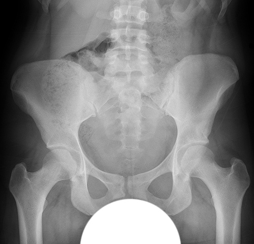 X-rays: PAO treatment of hip dysplasia, before and after.