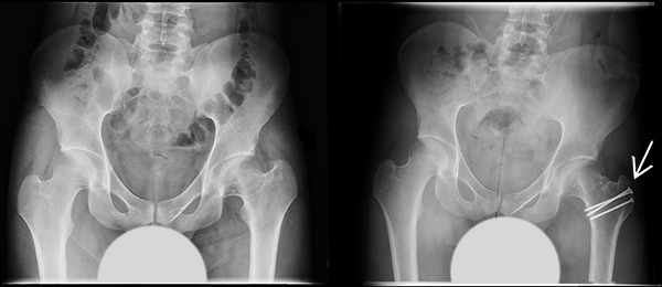 Anterior to posterior X-ray view, before and after surgical dislocation of let hip.