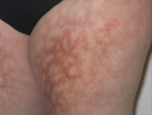 Blood cancer rash images