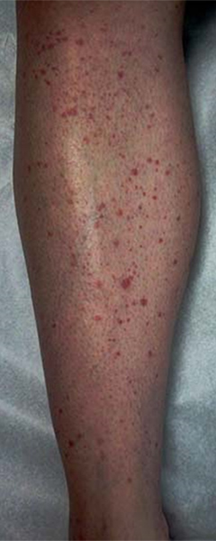 Photo of small-vessel vasculitis rash known as “palpable purpura.”