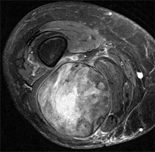 MRI view of a leiomyosarcoma soft-tissue sarcoma.