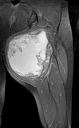 MRI view of a fibromyxoid soft-tissue sarcoma.