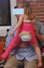 Photo of a young patient from the rear in a spica cast, which immobilizes the leg after realignment.