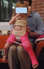 Photo of a young patient from the front in a spica cast, which immobilizes the leg after realignment.