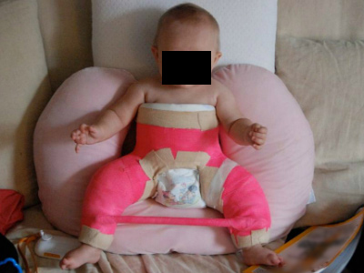 Tips for Caring for Your Child in a Spica Cast HSS