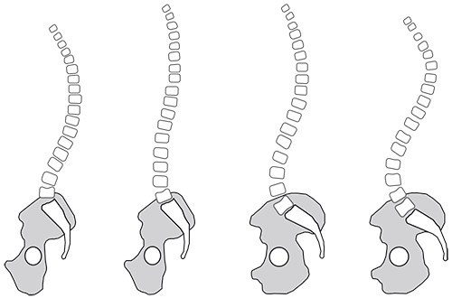 Types of spinal curvature as seen from the side. Some spines have greater curves than others.