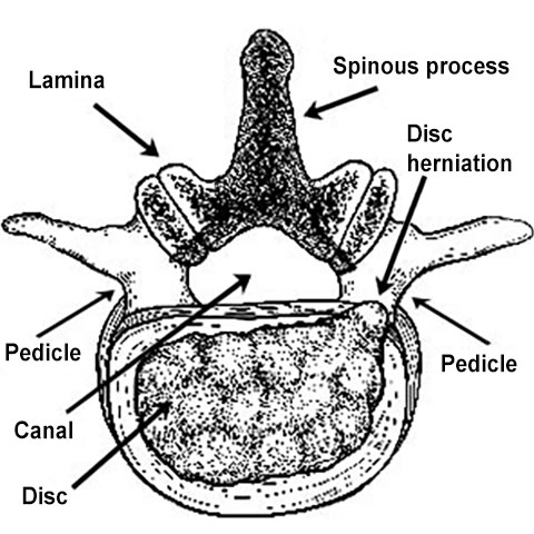 Illustration of a cross-section of a spinal vertebra showing a disc herniation.