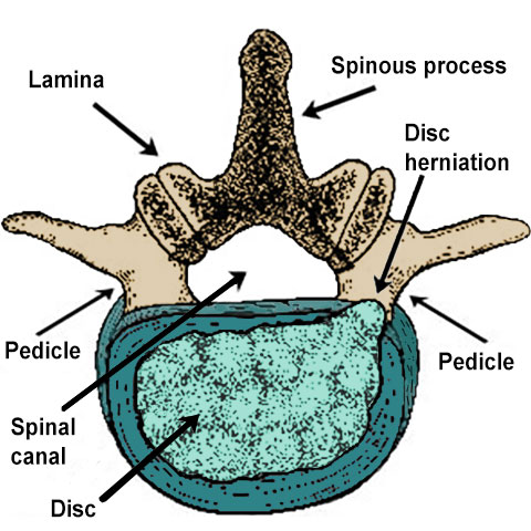Lumbar Disc Herniation Frequently Asked Questions HSS Spine
