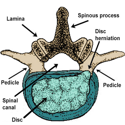 Spinal Stenosis Treatment Options - Advanced Wellness Solutions