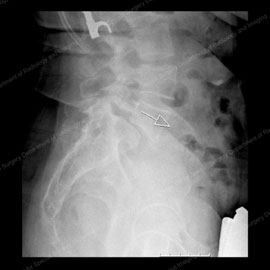 X-ray showing anterior spondylolisthesis, also known as anterolisthesis.