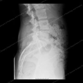 X-ray showing a lateral view (from the side) of a normal spine.