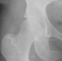 X-ray of hip joint