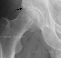 X-Ray of arthritic hip