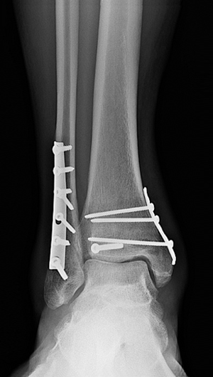 fractured ankle x ray