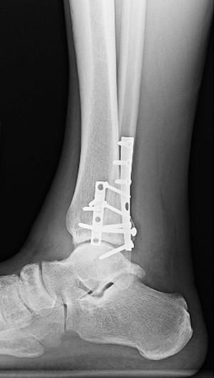 X-ray image showing side view of surgical plates and screws to treat a the trimalleolar fracture