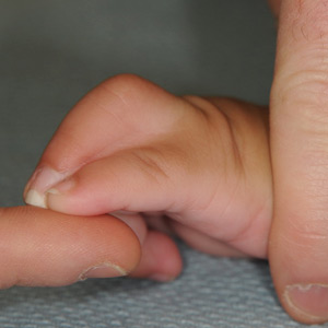 Lateral view of syndactyly of fifth and sixth finger.