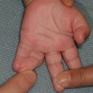 Palmar view of syndactyly of fifth and sixth finger.