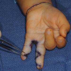 Palmar view of syndactyly of fifth and sixth finger after surgical separation. 