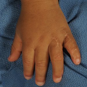 Dorsal view of multiple finger syndactyly after all digits have been surgically separated.