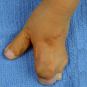 Multiple finger syndactyly after surgical separation of the thumb.