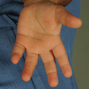 Palmar view of multiple finger syndactyly after all digits have been surgically separated.