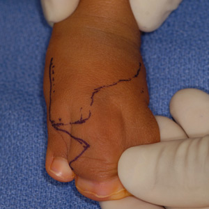 Dorsal view of multiple finger syndactyly during surgical planning.