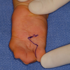 Palmar view of multiple finger syndactyly during surgical planning.