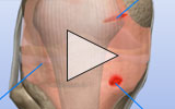 Video icon for synovial painful plica removal animation