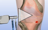 Video icon for the inflamed synovial tissue removal animation
