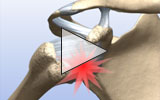 Animation: Bankart lesion repair surgery