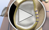 Animation: Repair of Detached Glenoid Labrum