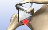 Animation: Minimally invasive surgery to repair capsule and labral damage in the shoulder and prevent instability and dislocation