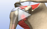 Play the animation - shoulder surgery for synovial problems