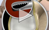 Animation thumbnail: Surgery to Trim a Torn Shoulder Labrum