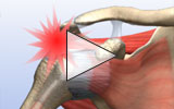 View fully torn rotator cuff animation