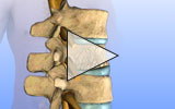Animation: Spinal compression fracture.
