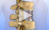 Animation of lumbar vertebral body replacement.
