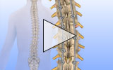 Thumbnail image of thoracic derotation surgical animation