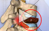 Animation Anterior thoracic vertebral body replacement.