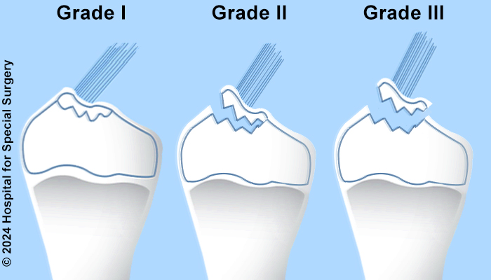 Illustration of tibial spine fracture grades I (nondisplaced), II (partially displaced), and III (completely displaced).