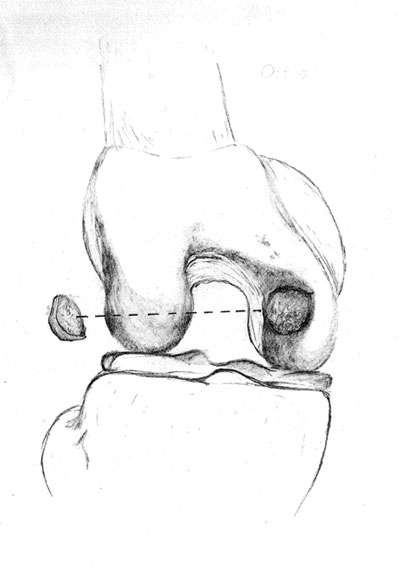 Diagram of a tibial spine fracture