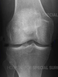 X-ray of a normal knee joint from an article about Arthritis of the Knee from Hospital for Special Surgery