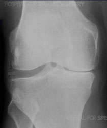 X-ray of an arthritic knee from an article about Athritis of the Knee from Hospital for Special Surgery