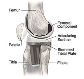 An image of a knee replacement implant within the knee joint from an article about Arthitis of the Knee from Hospital for Special Surgery