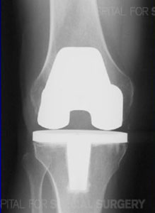 X-ray of a total knee arthroplasty from an article about Arthritis of the Knee from Hospital for Special Surgery
