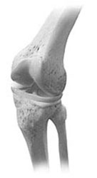 An image of the knee joint from an article about Arthritis of the Knee from Hospital for Special Surgery