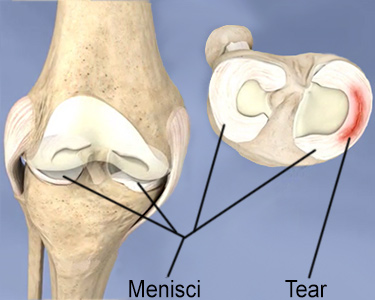 Diagram of the two knee menisci and of a meniscal tear.