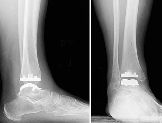 X-ray images of a total ankle replacement.