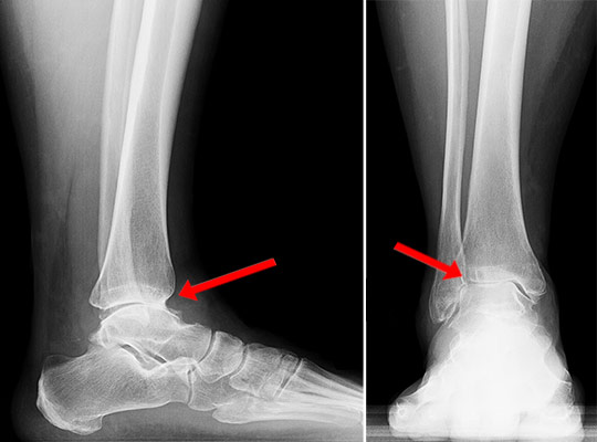 X-rays showing end-stage arthritis